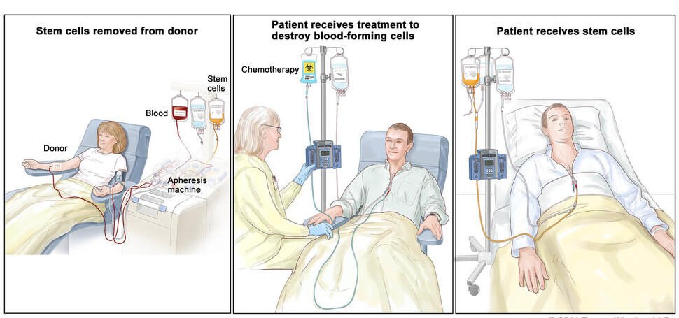 , Why Pelvic Floor Rehabilitation is Important for Bladder Cancer Patients